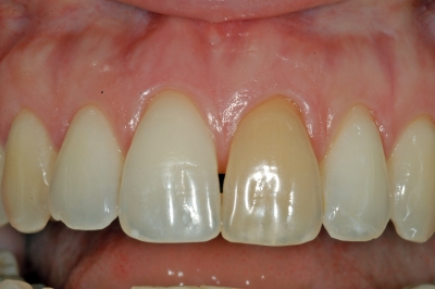 studio-odontoiatrico-viterbo-crea-dente-discromico